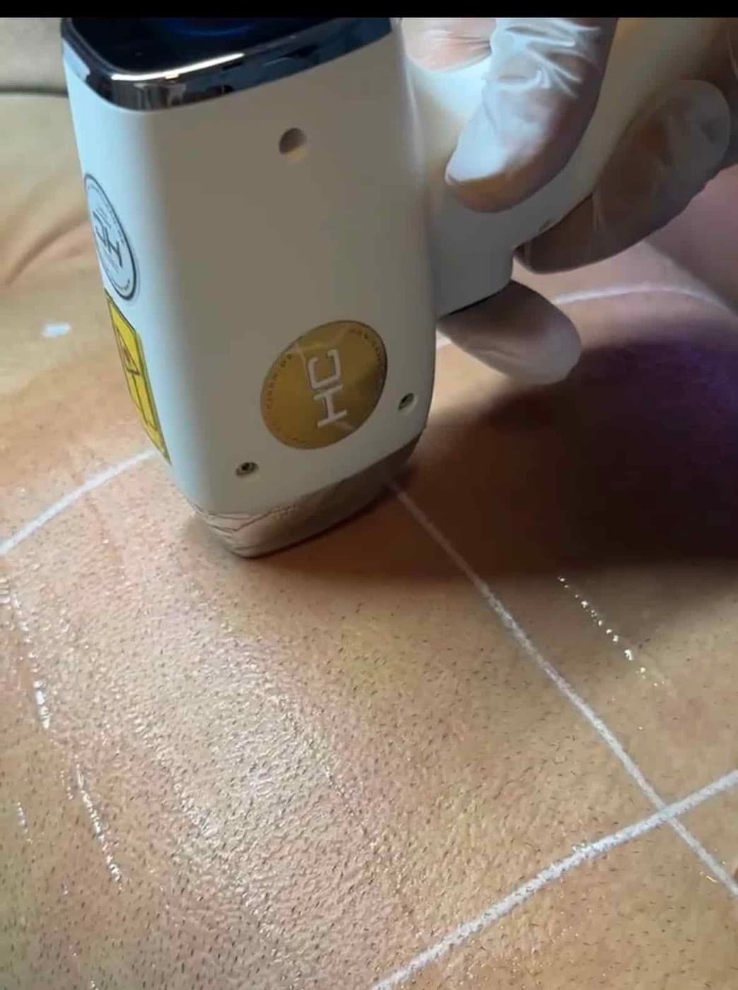 Laserhandstück während der Behandlung auf einer mit Behandlungsraster markierten Hautpartie